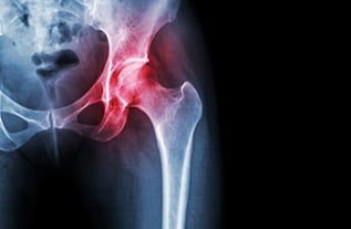 x ray show inflamed hip joint