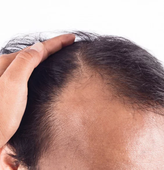 man hair loss