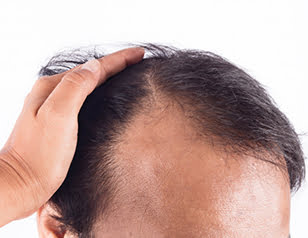 treat hair loss with therapy
