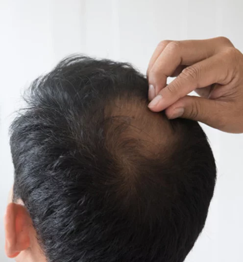 man thin hair on crown